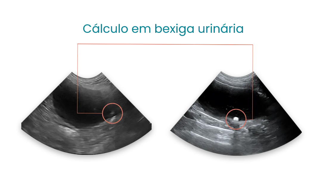 Thumb cálculo em bexiga urinária